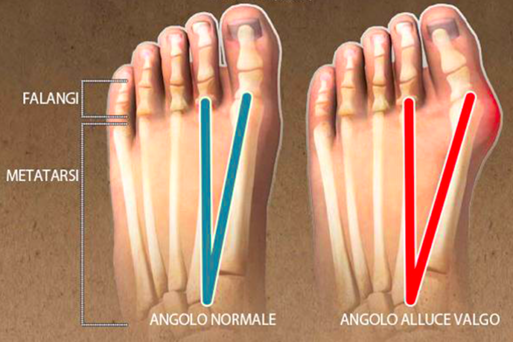L’alluce valgo: come viene e che cosa si può fare