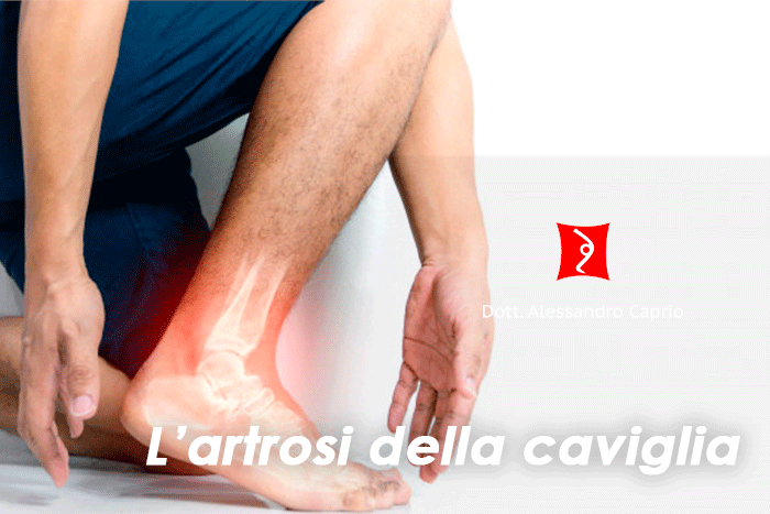 artrosi caviglia