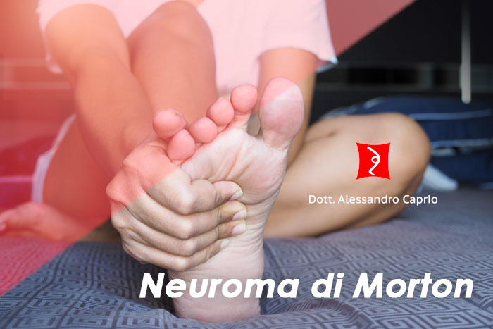 trattamento neuroma di morton