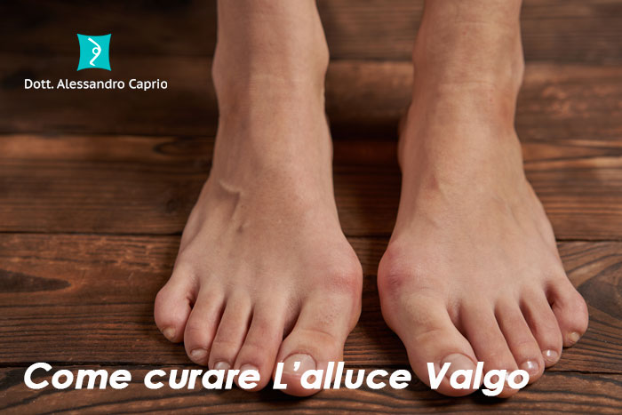 come curare l'alluce valgo